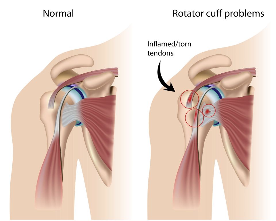 12 symptoms linked to right sided shoulder pain. Broken Yogi